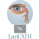 LacriCATH Transcanalicular DCR Balloon Cathater, 5 mm